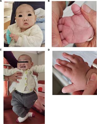 Frontiers | Case report: A study on the de novo KMT2D variant of